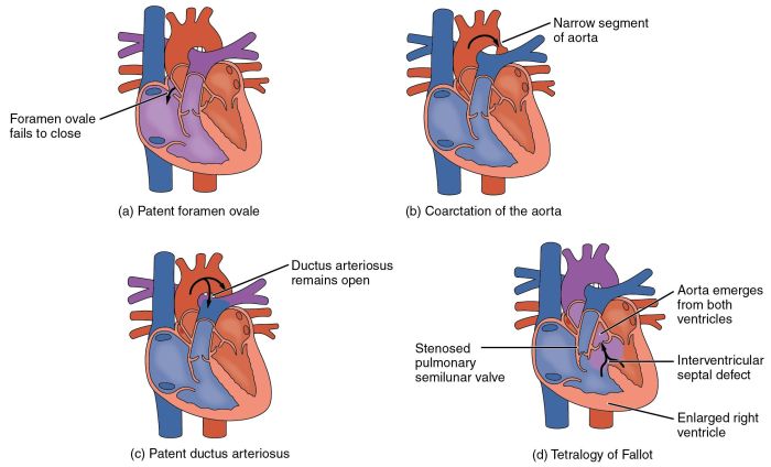 Disorders valvular