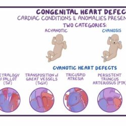 Congenital heart defects nclex questions